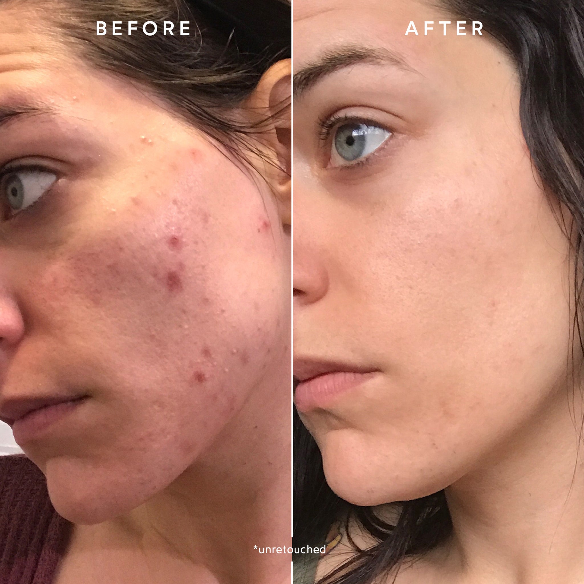CLEAR Repair Nightly Treatment for Acne & Blemishes - Gentle Overnight Skincare Solution for Clear, Healthy Skin - Perfect for Nighttime Routine & Travel