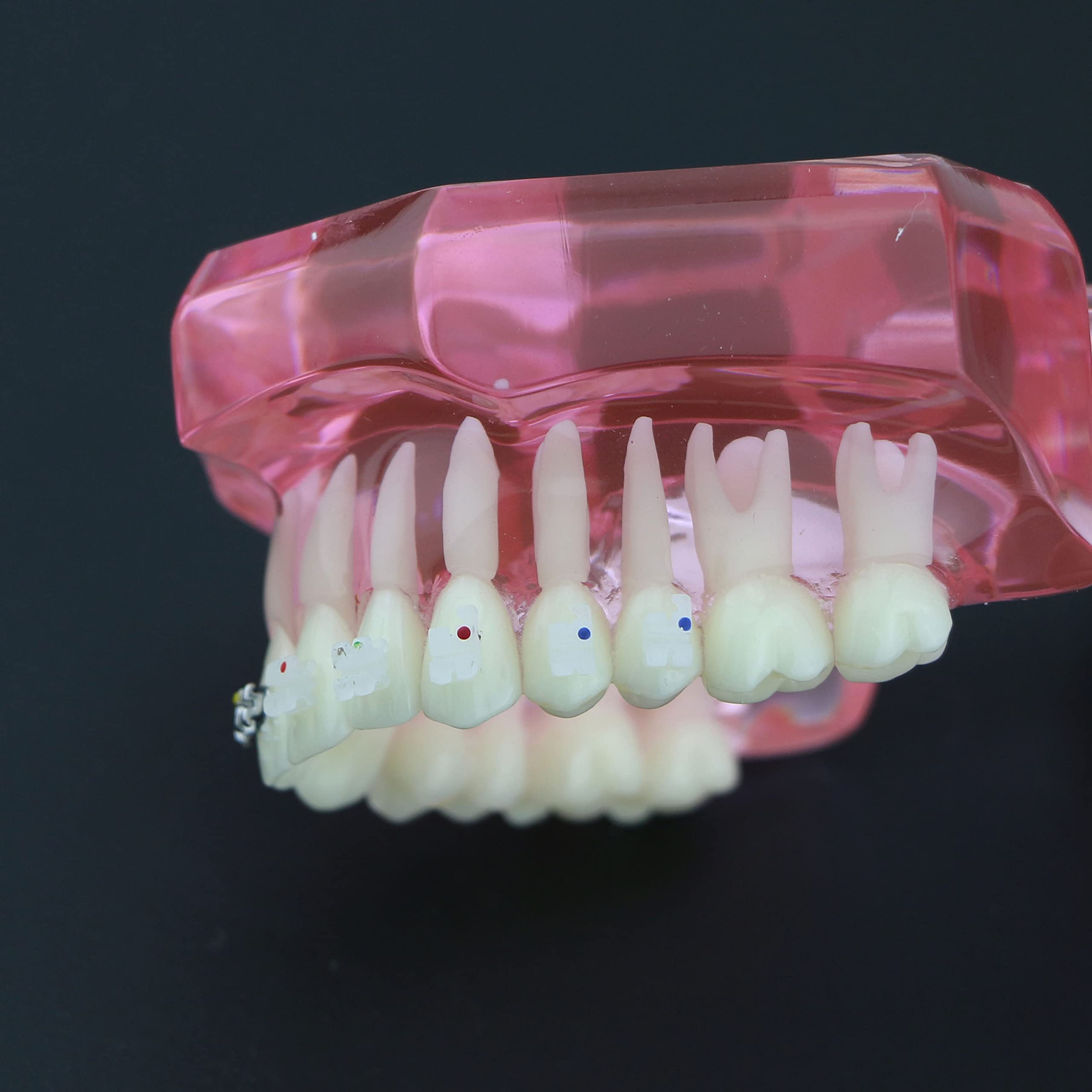 Dental Orthodontic Teeth Model with Metal & Ceramic Brackets - Professional Study Teeth Model for Dentists, Students & Orthodontic Training | Perfect for Dental Education, Practice & Office Display