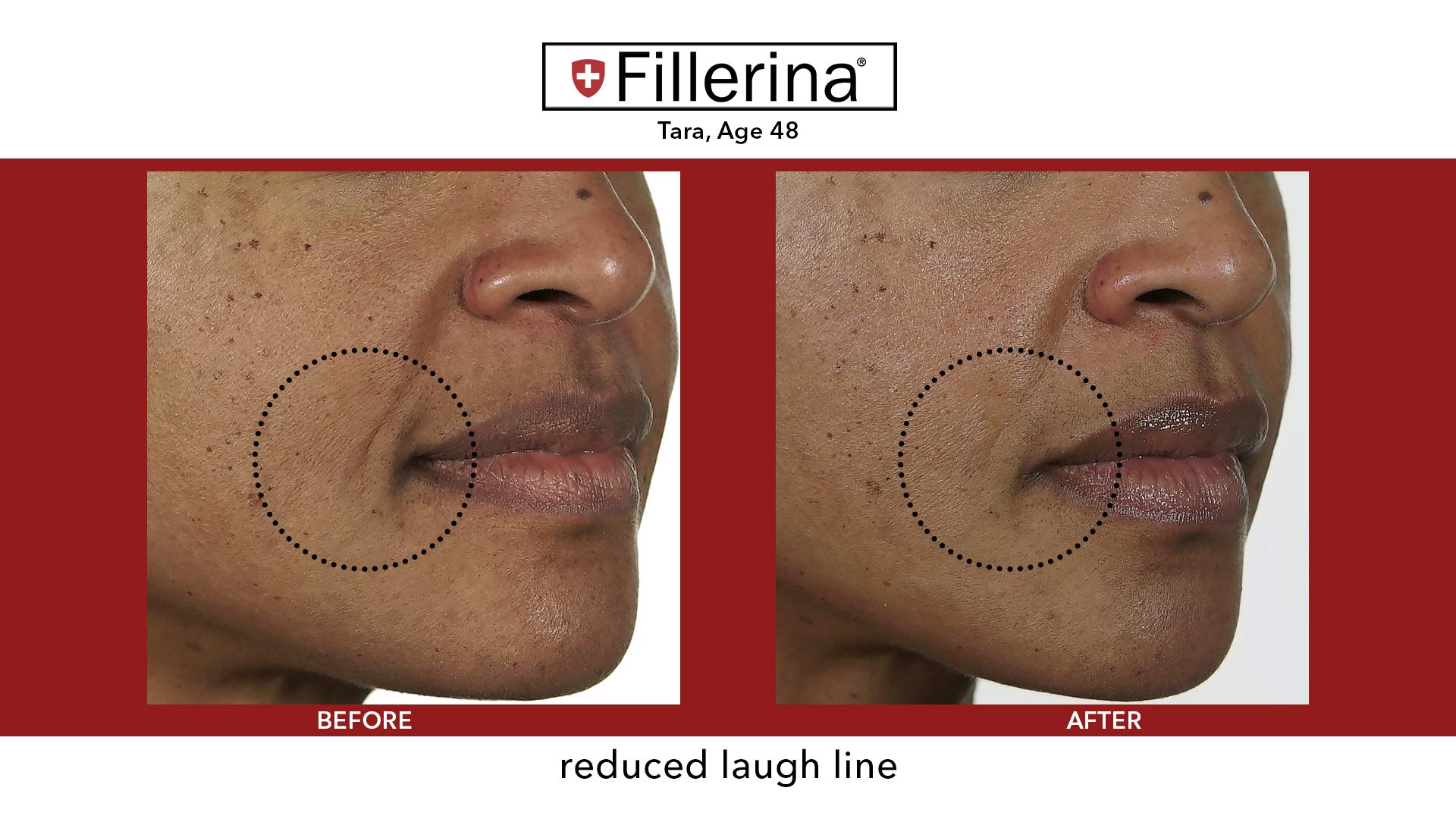 Fillerina Dermo-Cosmetic Grade 5 Plus Replenishing Gel for Face & Lips - 2x30ml + 2 Applicators | At-Home Wrinkle Treatment & Hydration | Perfect for Anti-Aging Routine & Dry Skin Care
