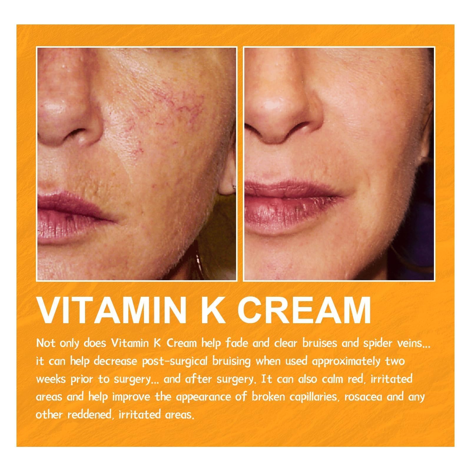 Best Varicose Veins Repair Cream with Vitamin K - Leg Vein Treatment for Men & Women - Soothing Relief for Spider Veins & Swollen Legs - Perfect for Daily Use at Home, Work or Travel