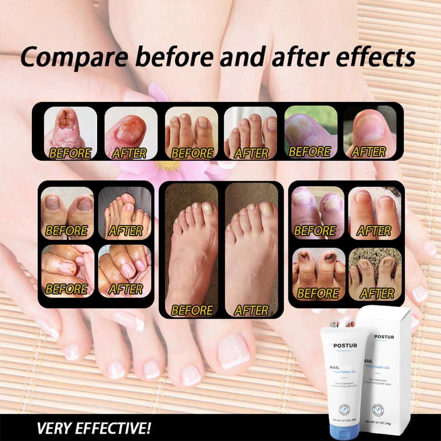 Postur Nail Gel - Fungus Treatment & Nail Care for Damaged & Discolored Nails - Strengthens & Restores Healthy Nails - Perfect for Toenail & Fingernail Fungus Treatment at Home (1pc)