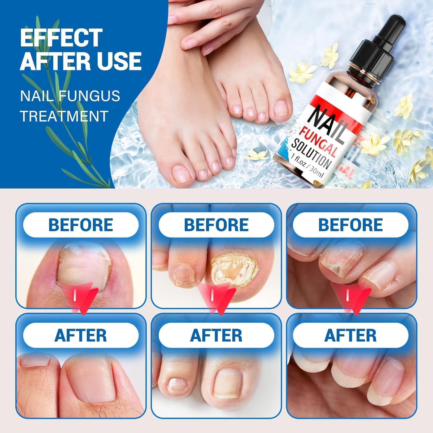 Extra Strength Toenail Fungus Treatment for Fingernails & Toenails - Safe & Gentle Nail Repair Solution with Softener (30ml) - Ideal for Athletes, Swimmers & Pedicure Enthusiasts