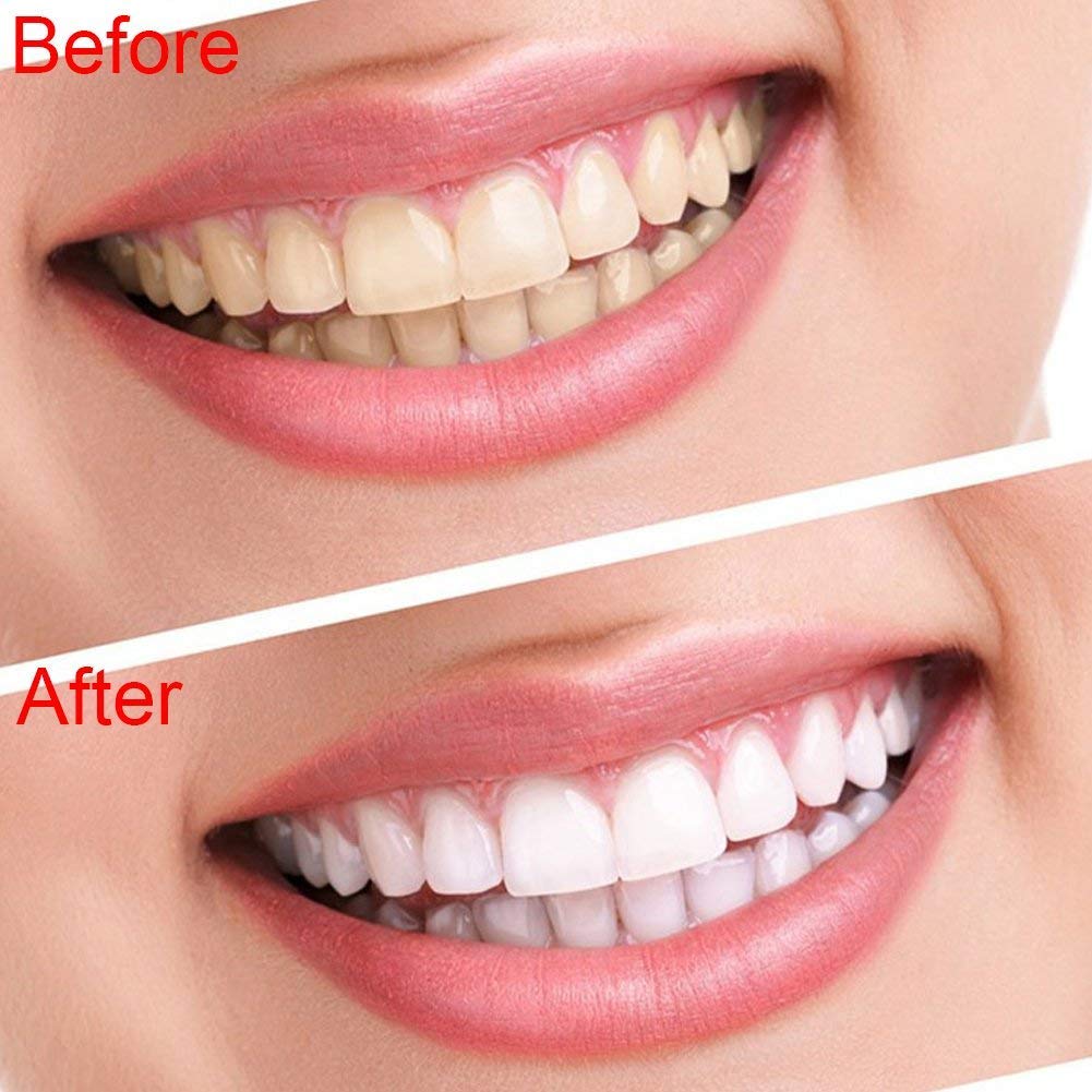 6 LED Teeth Whitening Light Lamp with 2 Goggles - Professional Teeth Bleaching Accelerator for Home Use, Perfect for Smile Brightening Before Events & Daily Oral Care
