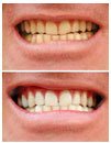 Professional Teeth Whitening Gel Syringe - 36% Carbamide Peroxide, 10ml for Instant White Smiles - Includes Whitening Trays - Perfect for At-Home Teeth Whitening & Brightening Your Smile for Special Occasions