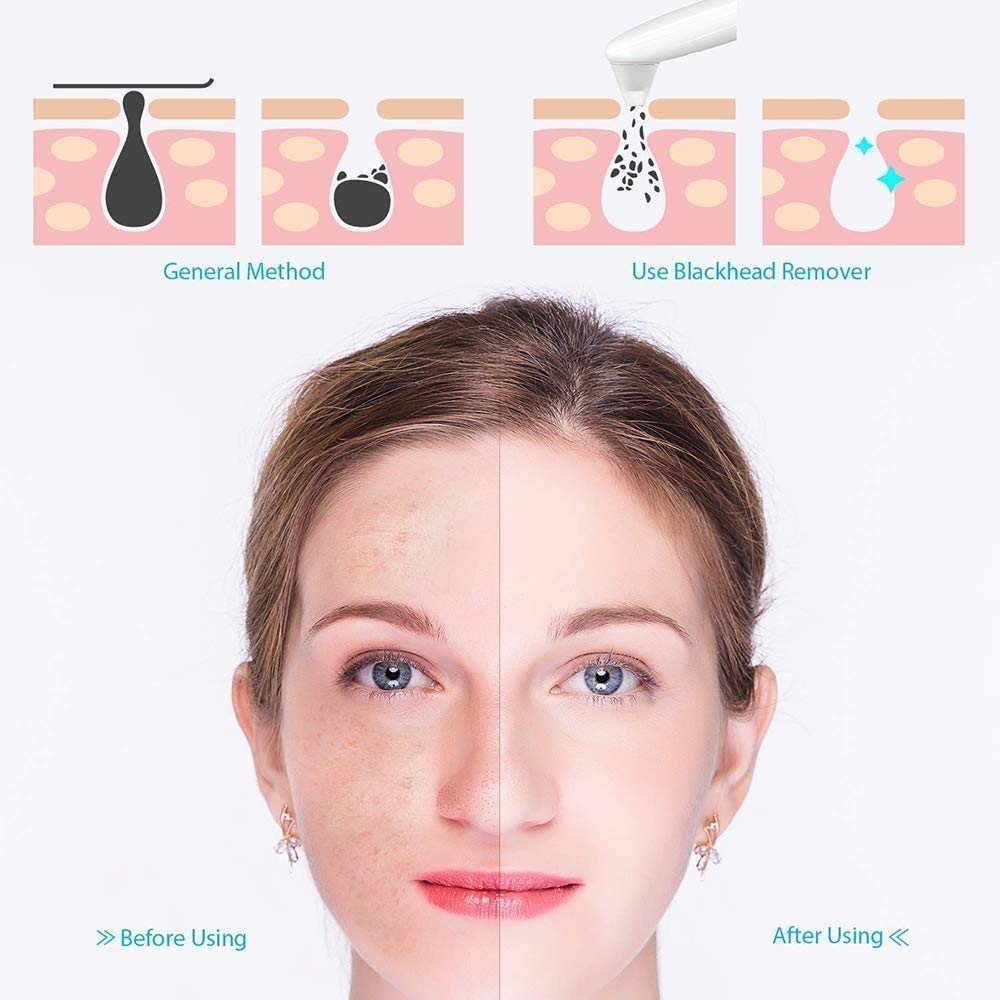 **Electric Blackhead Remover Pore Vacuum Cleaner - USB Rechargeable Facial Pore Cleaner for Acne, Comedones & Whitehead Removal | Perfect for At-Home Skincare & Spa Treatments**