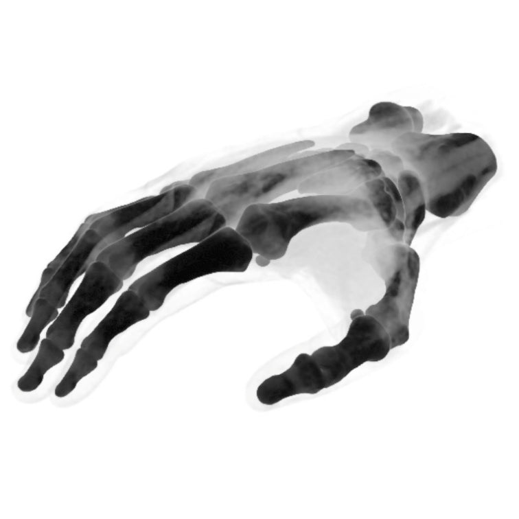 Hand Phantom Metacarpal Fractures for CT Scan & X-Ray Training - Medical Simulation Tool for Radiology Students & Emergency Practice