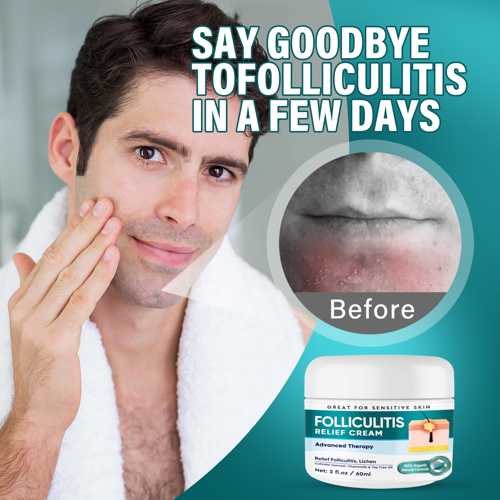 Dijkoo Folliculitis Treatment Cream for Face & Body - Severe Bumps & Irritation Relief for Men & Women - 60g - Soothes Razor Burns, Ingrown Hairs & Skin Inflammation | Perfect for Post-Shaving & Hair Removal Care