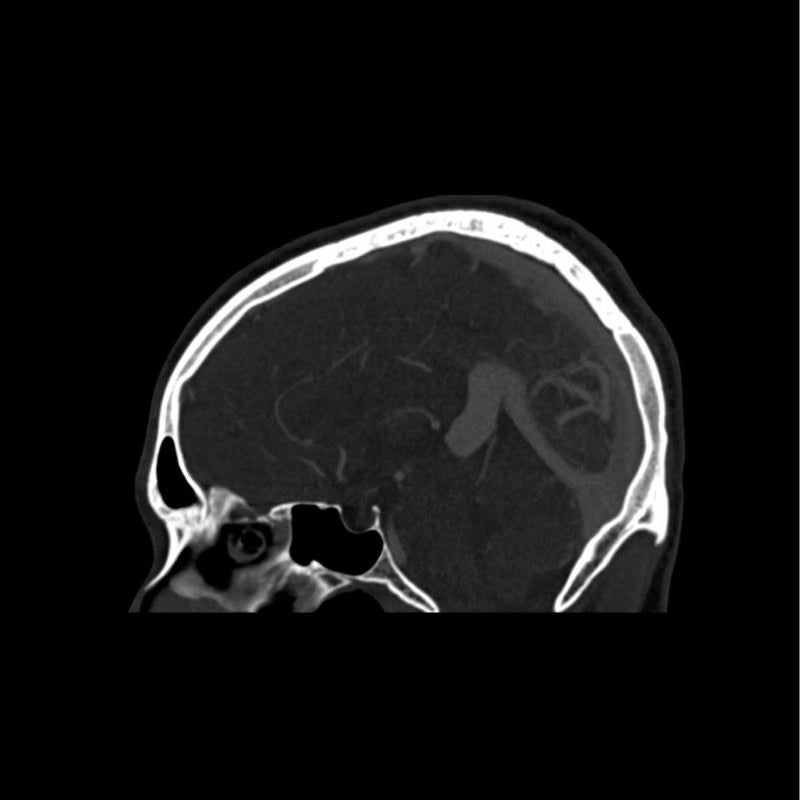 CTA AVM Head Phantom for CT Scan & X-Ray Training - Medical Imaging Practice, Radiology Education & Diagnostic Testing Simulation