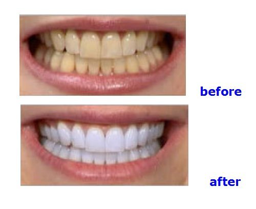 Nski Professional LED Teeth Whitening Light Accelerator Kit - 6000mw/cm² Powerful Bleaching Lamp for Teeth Whitening at Home - Fast & Effective Dental Care - US Stock (Model: YS-TW-A) - Perfect for Home Use, Travel, and Professional Dental Care