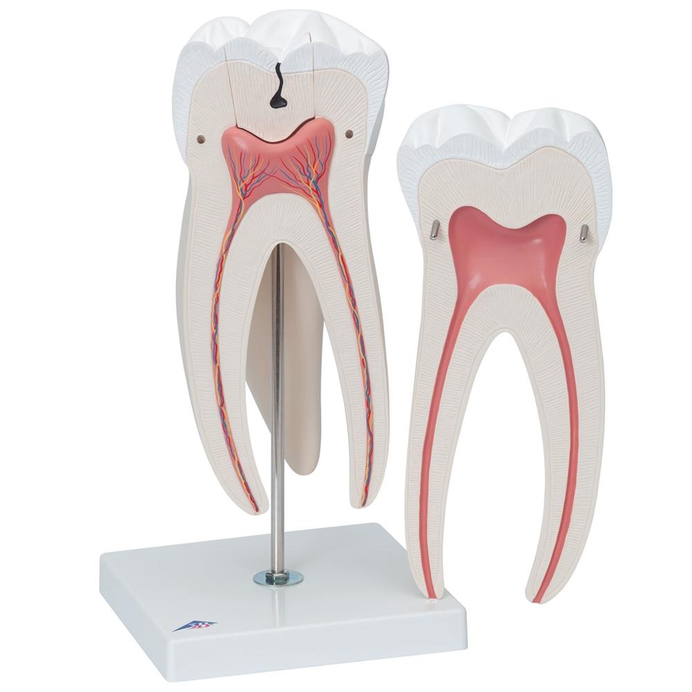 Giant Molar with Cavities - 15x Life Size Dental Model (5-Part) - Perfect for Dental Education, Classroom Demonstrations & Medical Training