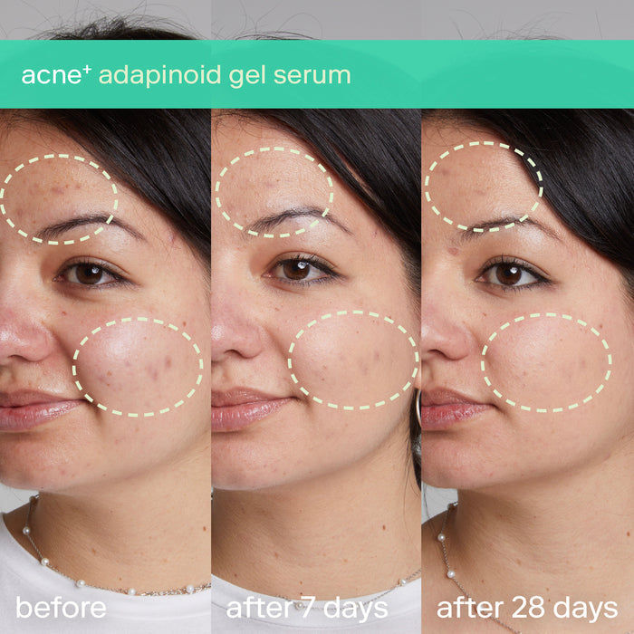 Acne+ Adapinoid® Gel Mini - Fast-Acting Acne Treatment for Clear Skin | Perfect Travel Size for On-the-Go Skincare