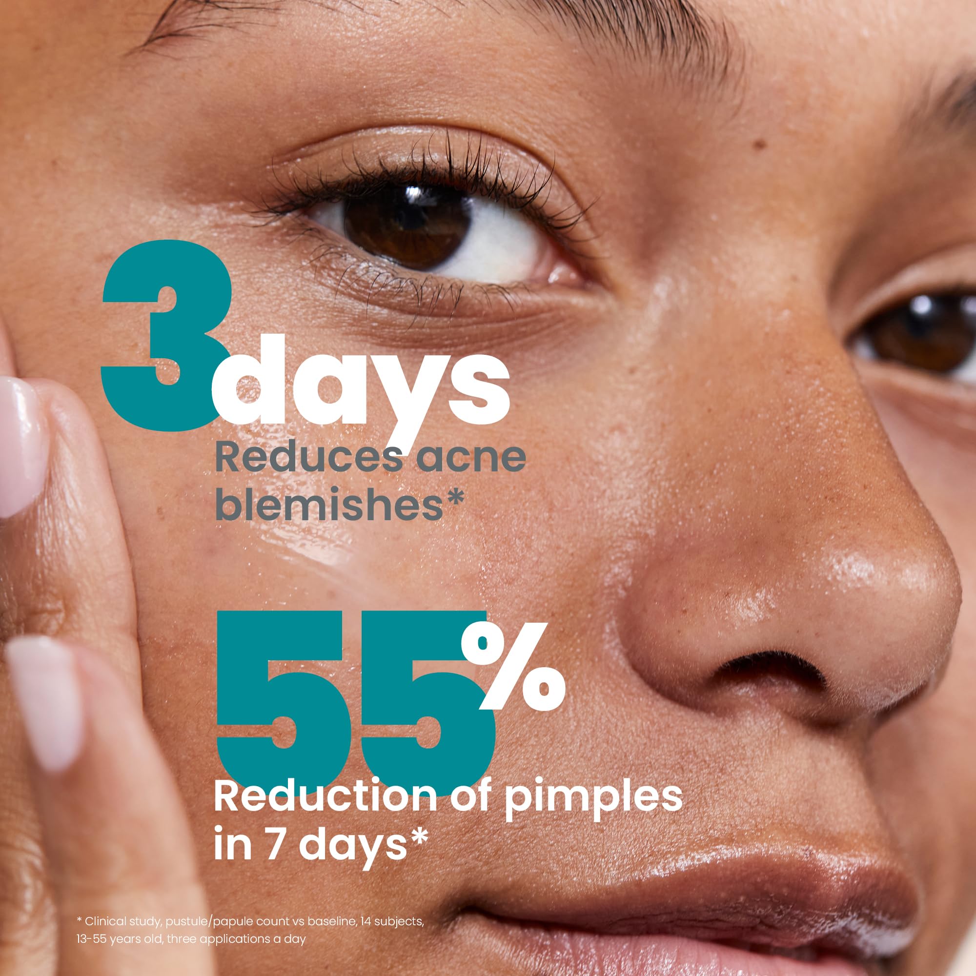 Avène Cleanance ACNE Medicated Clearing Treatment with Micronized Benzoyl Peroxide - Acne Treatment Cream for Blemishes & Blackheads - Gentle Formula for Sensitive Skin - Perfect for Daily Skincare Routine & Teen Acne Care