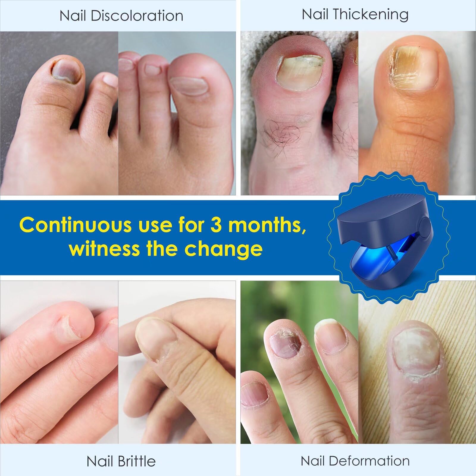 SUNCKY Toenail Fungus Treatment Device - Fast Acting LED Light Therapy for Discolored, Brittle & Cracked Nails - Blue Light Nail Repair Lamp - Perfect for Athletes, Pedicures & Home Foot Care