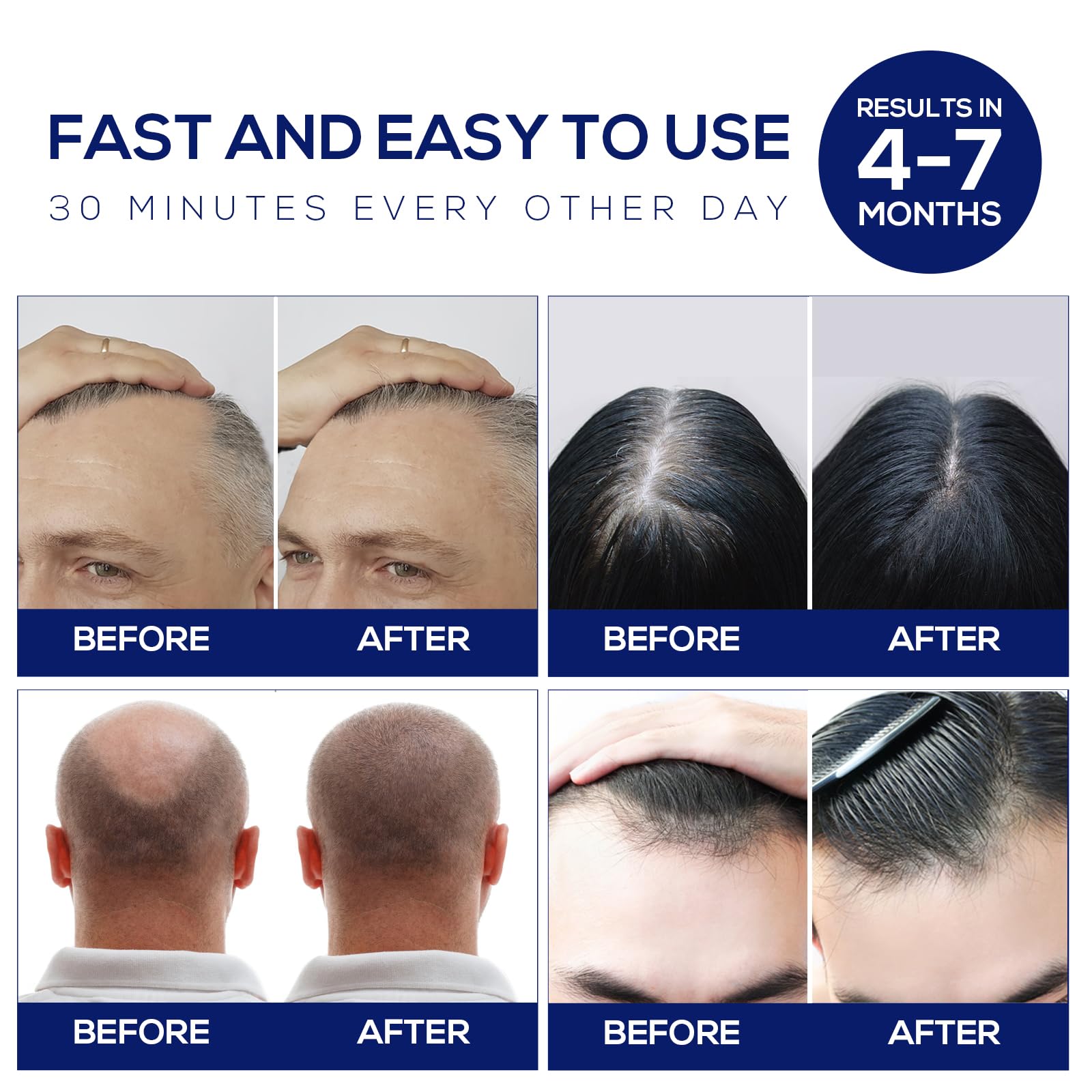 Laser Hair Growth Cap for Men & Women - Red Light Therapy Hair Loss Treatment System with Hair Regrowth Technology - At-Home Hair Restoration Solution for Thinning Hair (White) - Perfect for Daily Use at Home or Salon