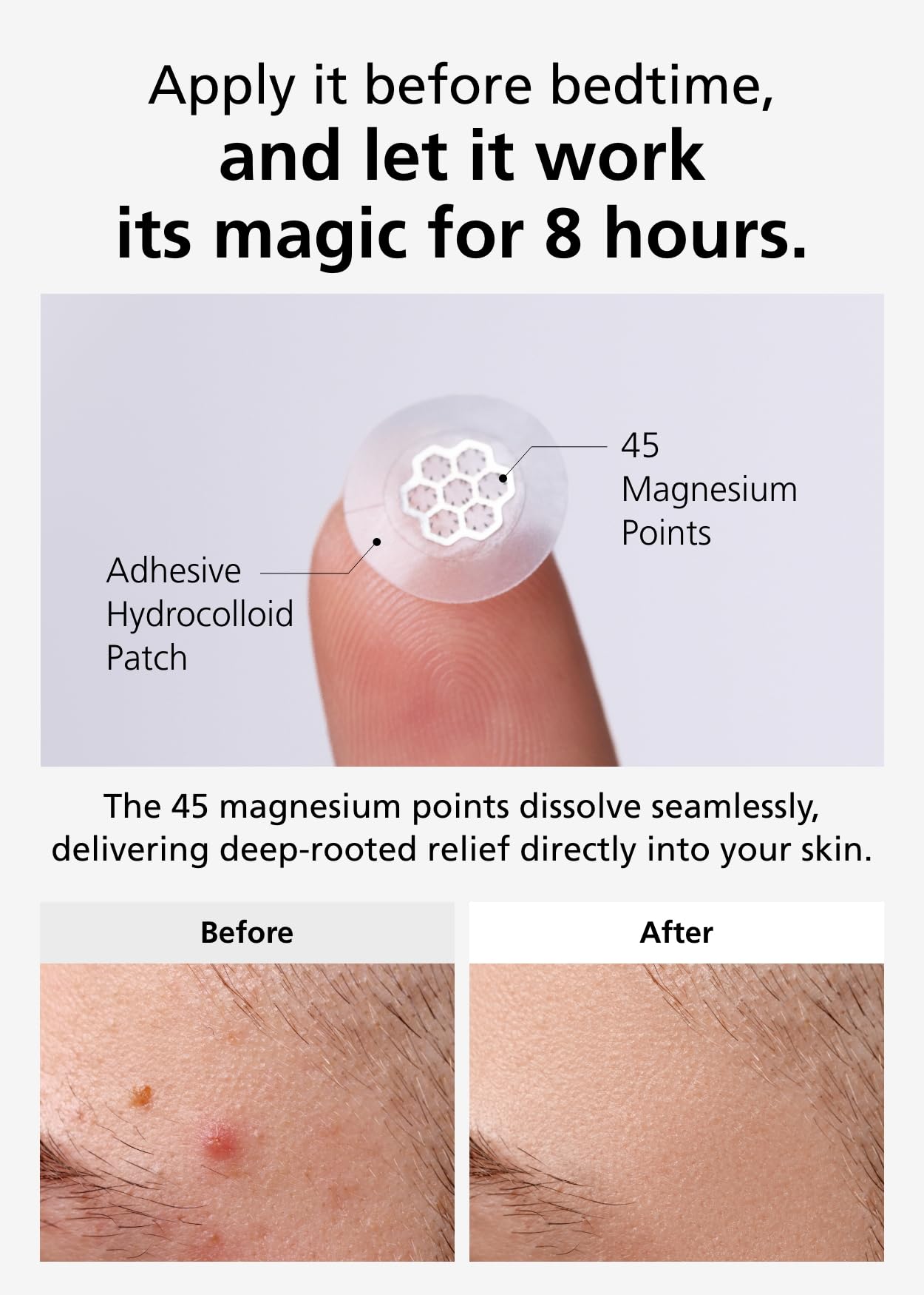 EasyDerm Quick Calming Magnesium Hydrocolloid Acne Patches - 10 Count Blemish Spot Treatment with Tweezers & Ampoule | TikTok Viral Zit Stickers by Daewoong Pharmaceutical | Perfect for Overnight Acne Relief & On-the-Go Skincare