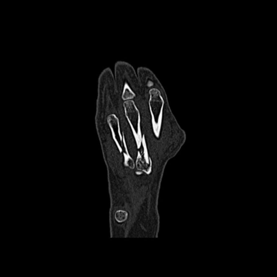 Hand Phantom Metacarpal Fractures for CT Scan & X-Ray Training - Medical Simulation Tool for Radiology Students & Emergency Practice