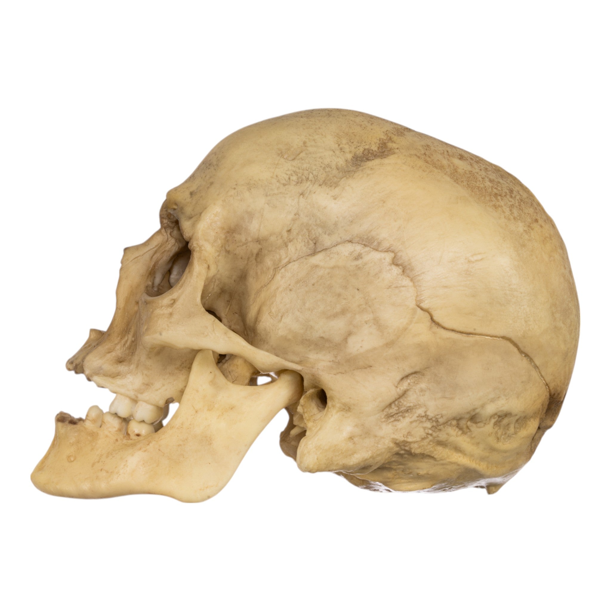 Realistic Replica Human Male Skull with 32 Caliber Gunshot Wound - Perfect for Medical Training, Forensic Studies, and Halloween Decorations