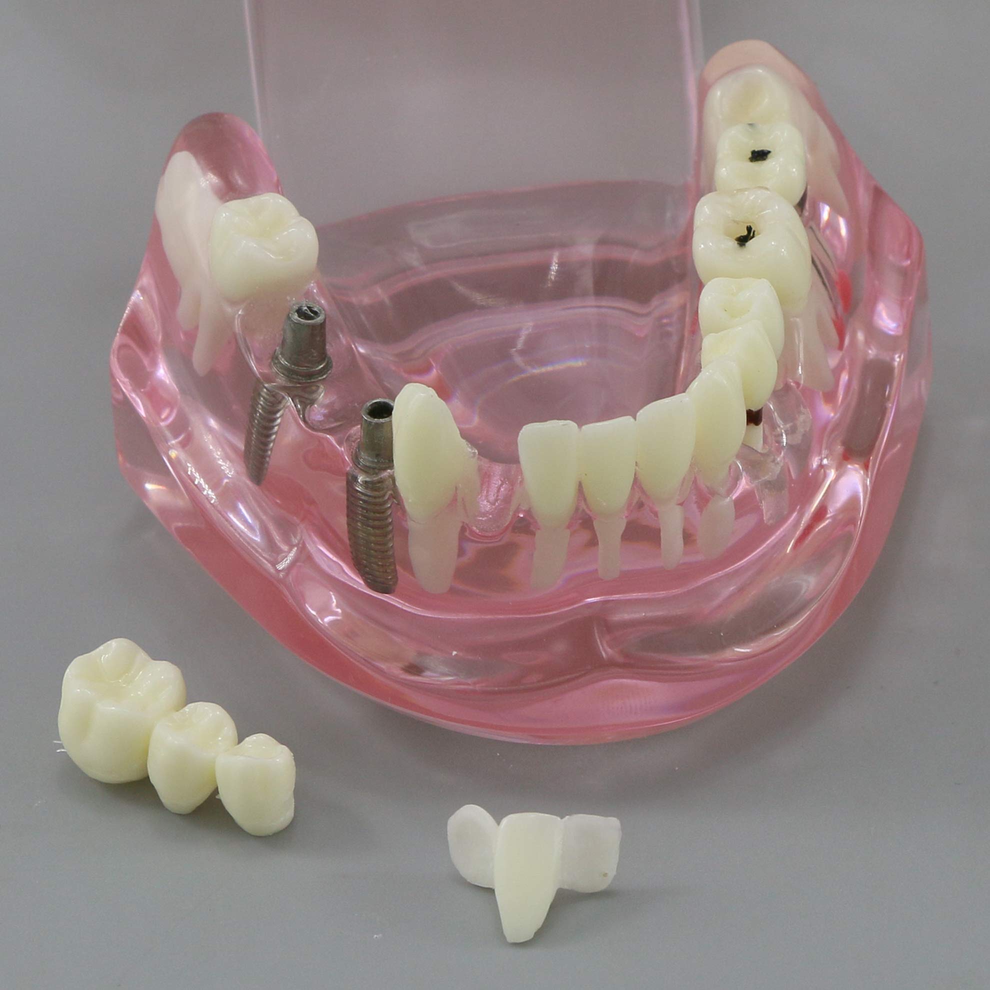Dental Implant Typodont Model M2001 - Pink Oral Pathology Teeth for Dental Teaching, Study & Practice | Perfect for Dental Schools, Clinics & Training Demonstrations