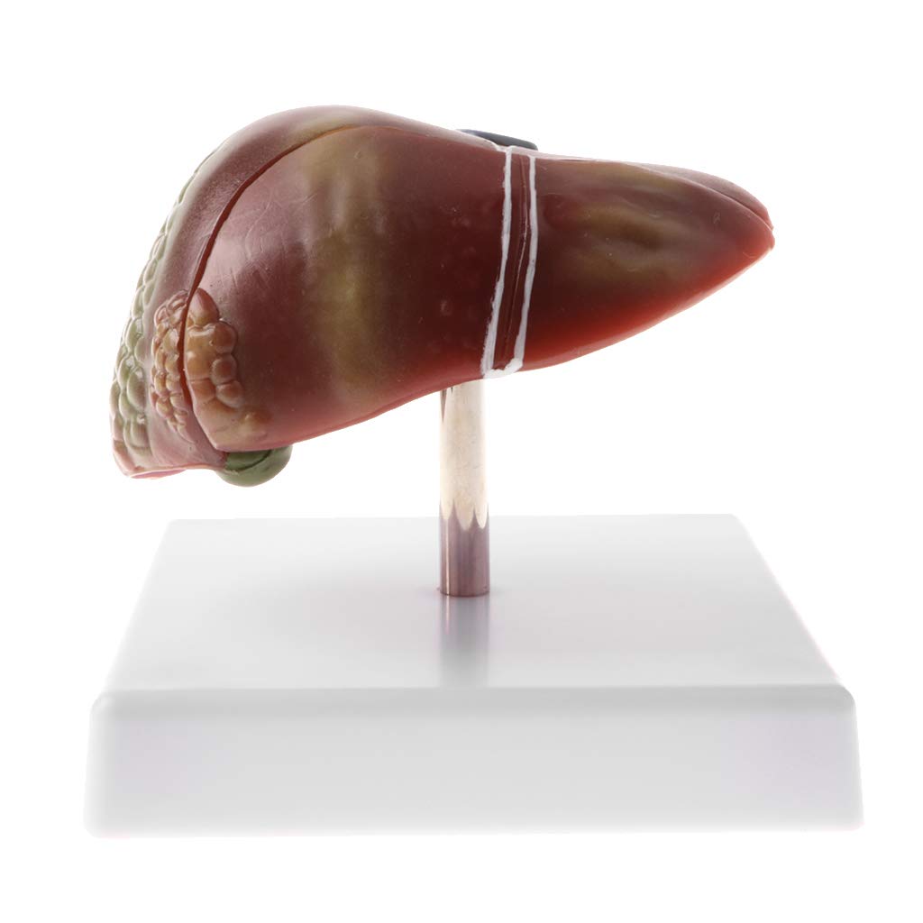Human Diseased Liver Model - Anatomical Pathology Teaching Tool for Medical Students & Professionals | Perfect for Medical Labs, Classrooms & Research Facilities