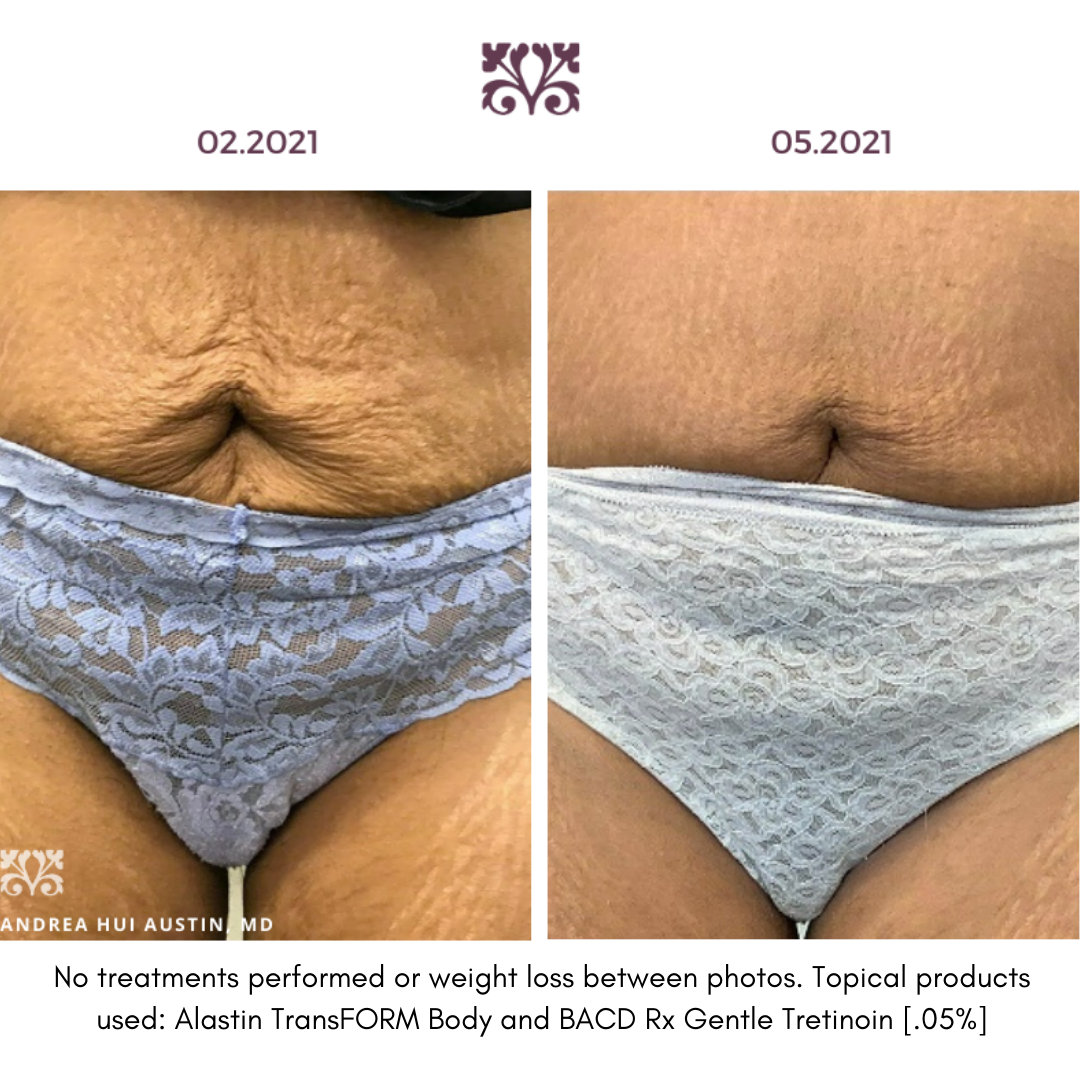 Alastin TransFORM Body Treatment - Anti-Aging Skin Care Cream for Firming & Tightening - Perfect for Post-Pregnancy, Weight Loss & Cellulite Reduction