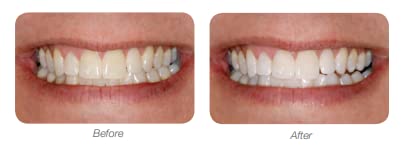 LumiSmile Professional Teeth Whitening Kit - 2 Pack 16% Carbamide Peroxide Whitening Syringes (2.5ml Each) for At-Home Use | Brighten Smile Safely & Effectively | Perfect for Weddings, Job Interviews & Special Occasions