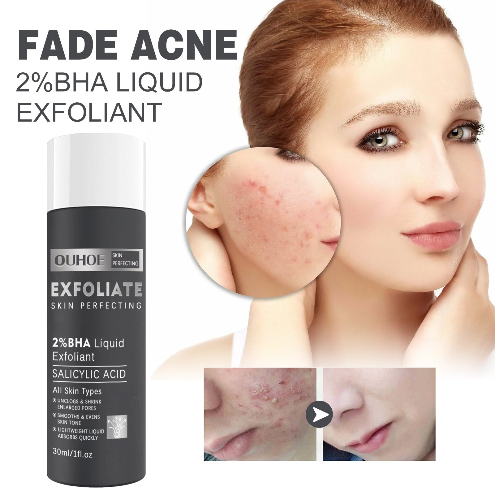 Salicylate Acne Treatment Cream - Skin Repair & Care for Clear Complexion | Perfect for Daily Skincare Routine & Blemish Control