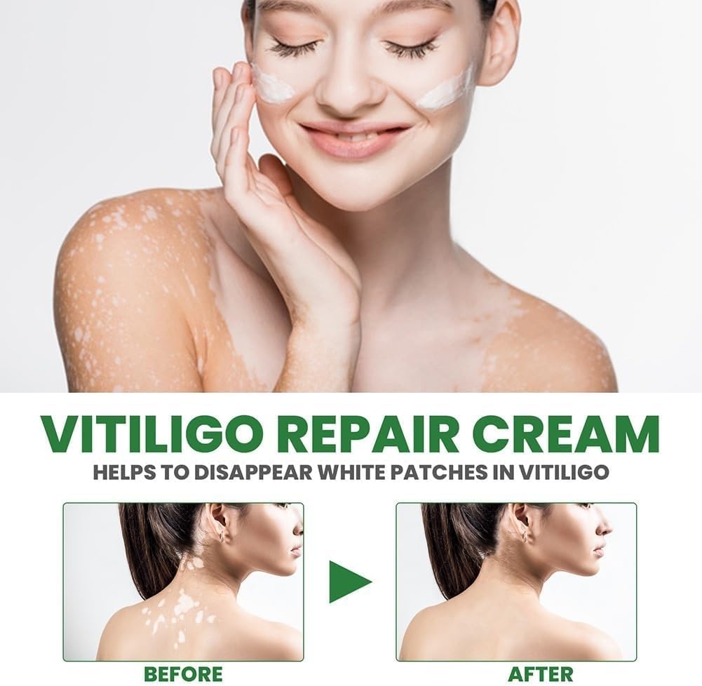 Vitiligo Treatment Cream - White Spot Remover & Skin Pigmentation Corrector | Soothing Moisturizer for Vitiligo Care | Reduces White Patches & Improves Skin Tone (2 Pack) - Ideal for Daily Skincare Routine & Spot Treatment