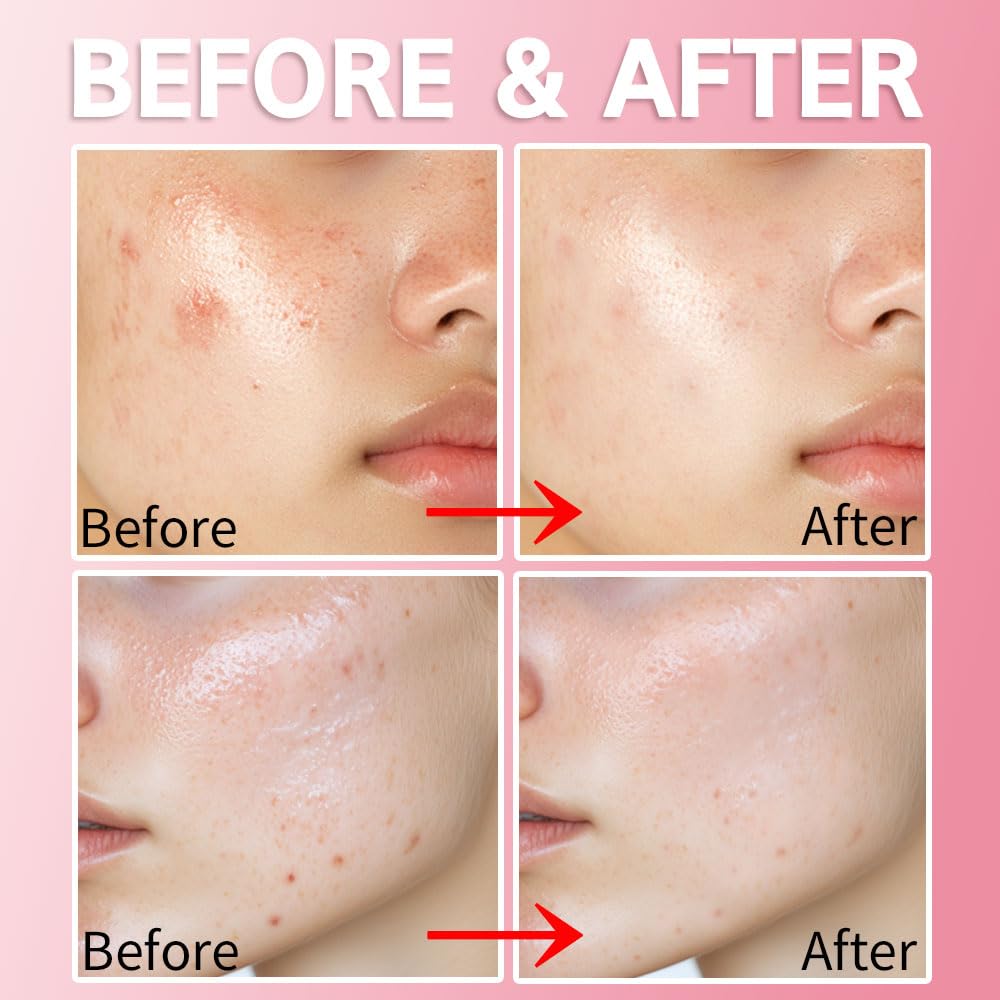 Purederm Blemish Spot Treatment Gel with 2% Salicylic Acid - Soothing Acne Care for Irritated Skin - Day & Night Use - 20ml - Perfect for Teen & Adult Acne, Breakouts & Sensitive Skin Care