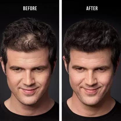 SKINPLUS Hair Fiber for Men - Black Hair Building Powder & Thickening Fibers for Instant Volume & Coverage | Perfect for Thinning Hair & Bald Spots | Styling Wand Included for Easy Application at Home or On-the-Go