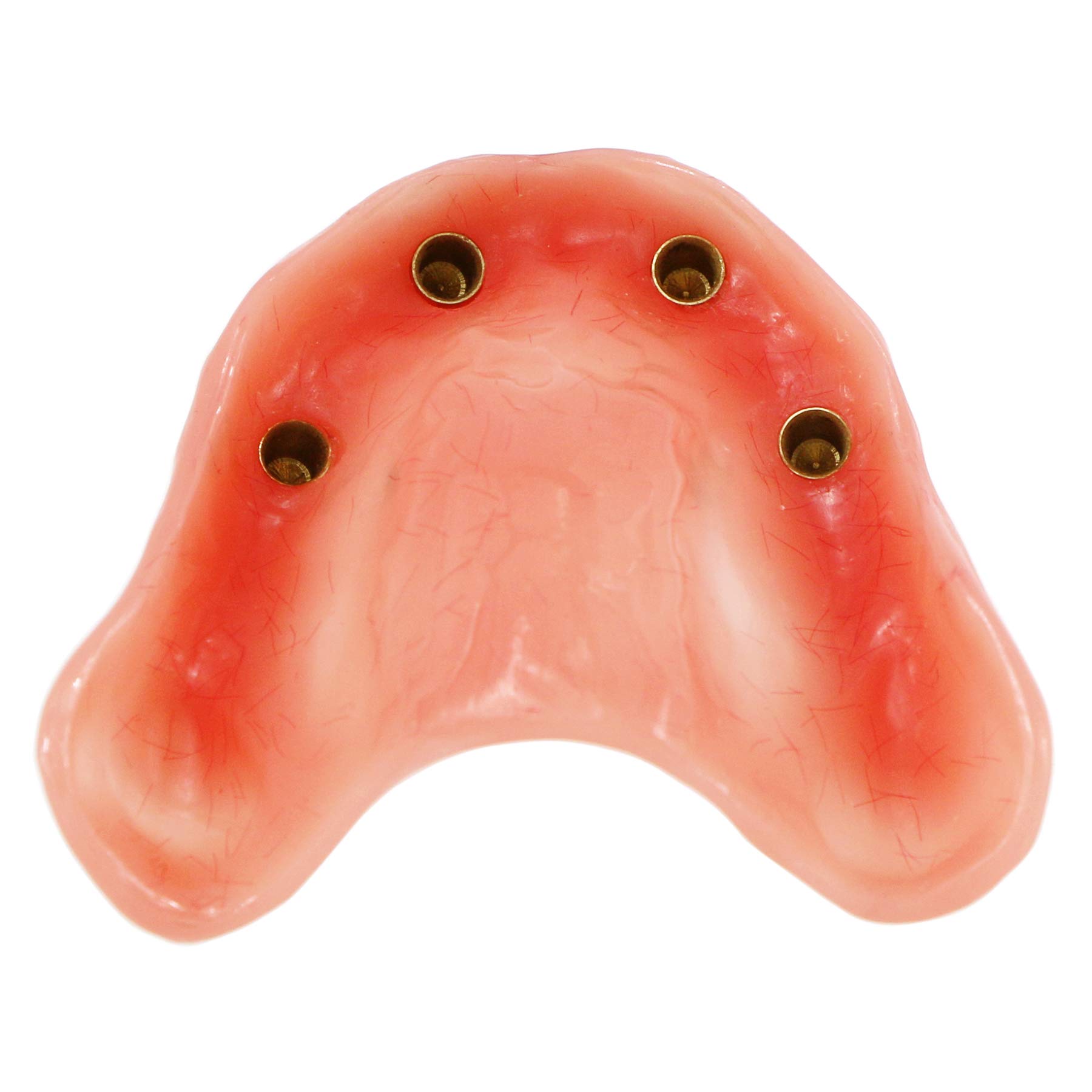 Dental Implant Typodont Model M6001 - Pink Upper Jaw Overdenture with 4 Implants for Superior Restoration | Ideal for Dental Students, Teaching & Clinical Practice