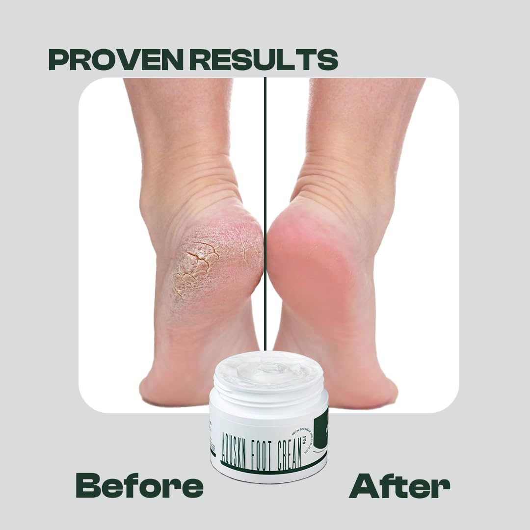 Wuba Aquskn Foot Cream for Dry & Cracked Feet – 50gm Cracked Heel Repair Cream with Urea, Diabetic Foot Care, Moisturizing & Soothing Treatment – Paraben & Mineral Oil Free – Visible Results in 7 Days – Perfect for Daily Foot Care, Cracked Heel Treatment & Diabetic Skin Relief