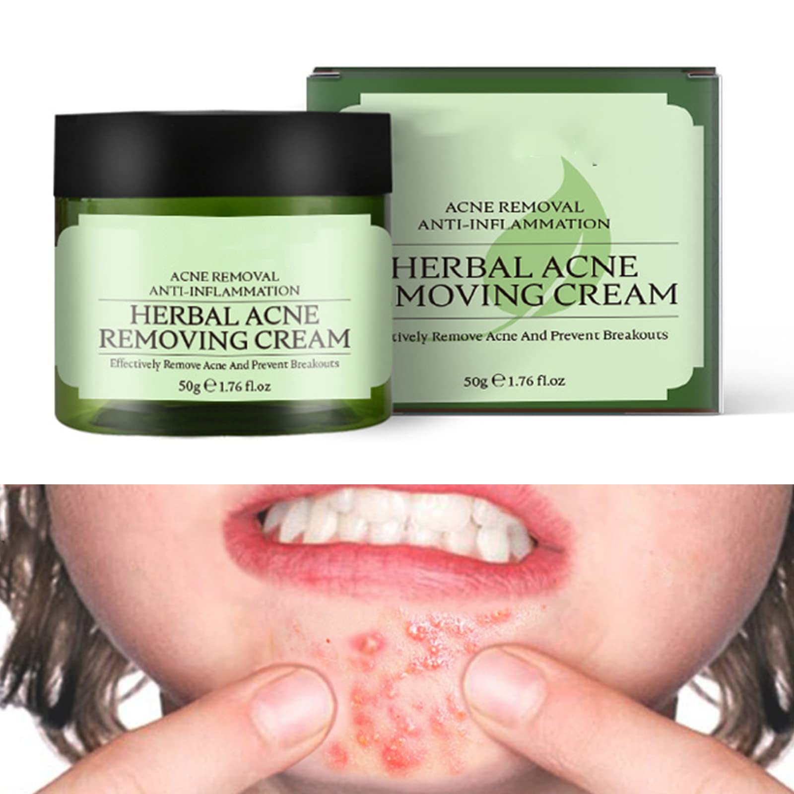 Best Tea Tree Acne Cream for Face - Moisturizing Spot Treatment for Men, Women & Teens - Reduces Acne, Balances Oil & Fades Marks - Perfect for Daily Skincare & Sensitive Skin Care Routine