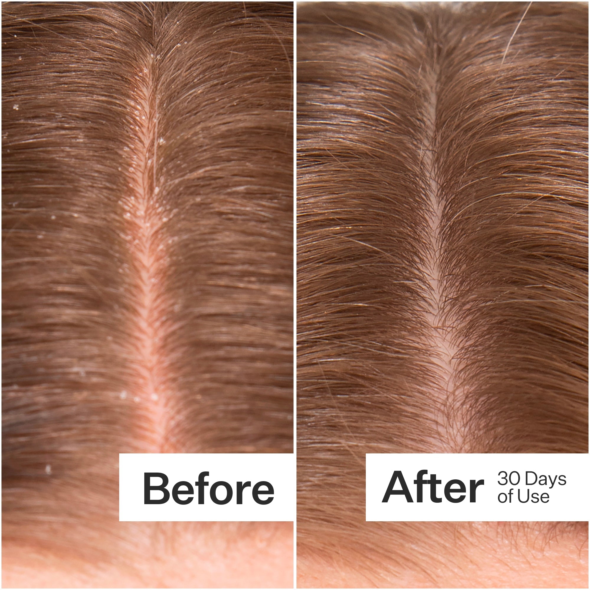Act + Acre Microbiome Cooling Scalp Serum for Dry & Itchy Scalp - Soothing Treatment for Dandruff & Irritation - Perfect for Daily Hair Care Routine & Scalp Refreshment