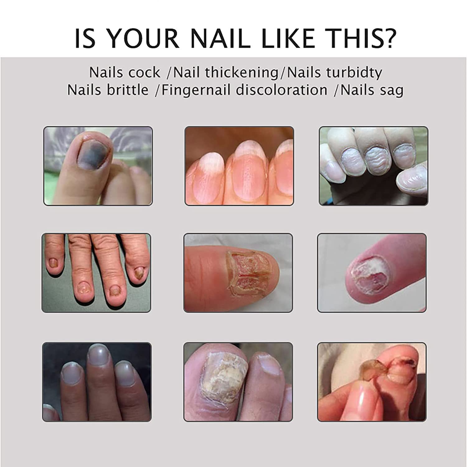 Flyles Nail Repair Treatment Gel - Restores Discolored & Damaged Nails, Strengthens & Protects Natural Nails (2 Pack) | Perfect for Manicures, Nail Care Routine & Salon Treatments