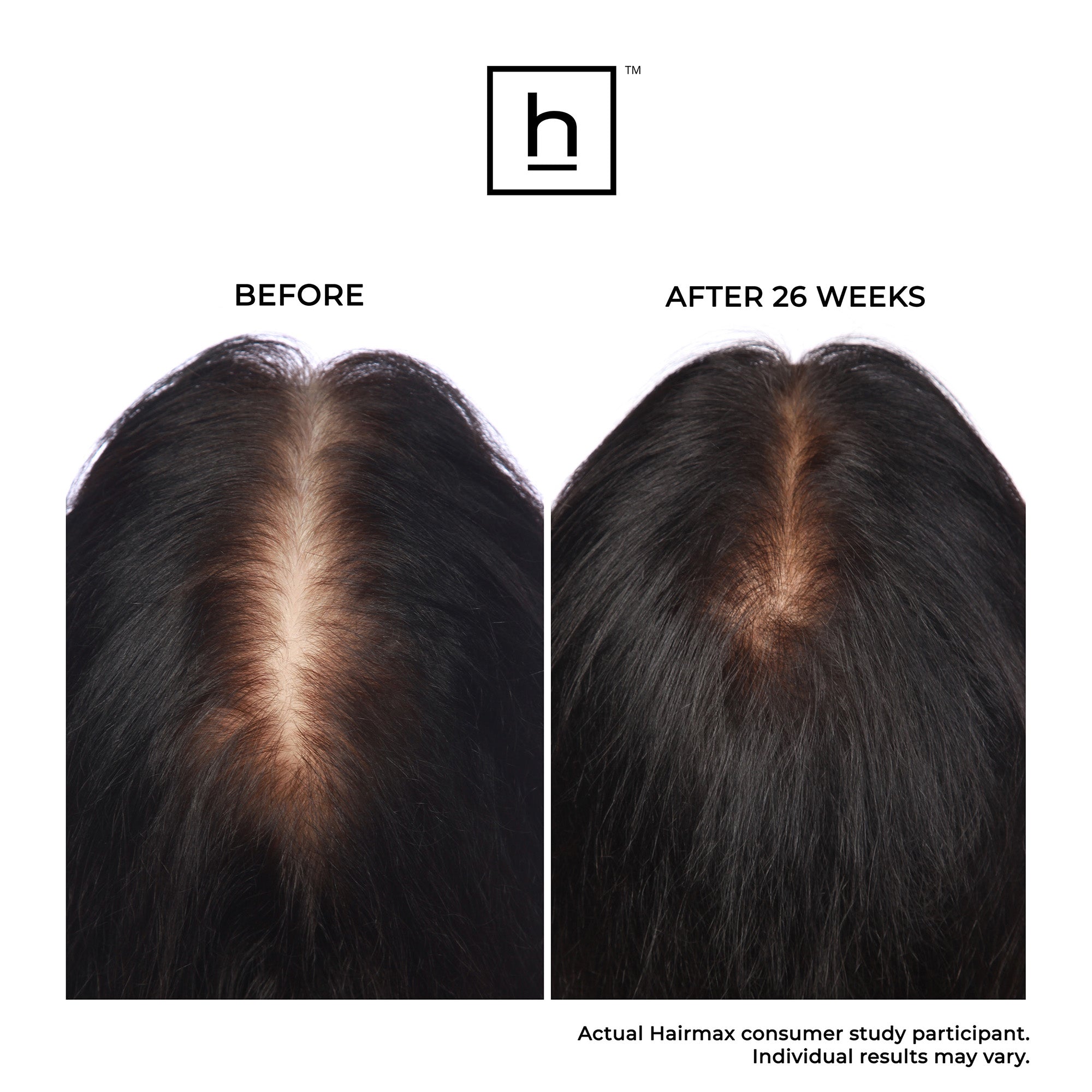 HairMax LaserBand 82 ComfortFlex FDA-Cleared Laser Hair Growth Device for Women & Men - At-Home Hair Loss Treatment for Thicker, Fuller Hair | Perfect for Daily Use & Travel
