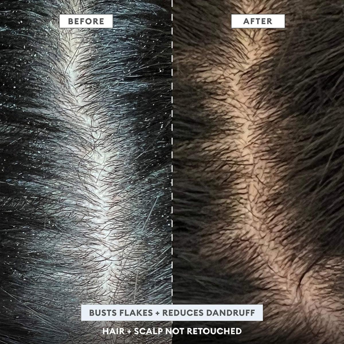 MegaStrength+ Anti Dandruff Shampoo with Charcoal & AHA/BHA - Soothes Itchy Scalp & Flakes for Men & Women - Daily Use for Healthy Hair Care