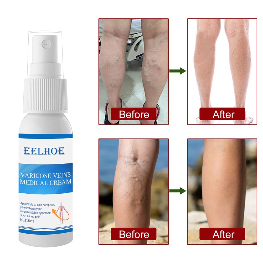 Varicose Veins Miracle Cream - Spider Vein Treatment for Legs | Phlebitis Relief & Muscle Soreness Solution | Fast-Acting Leg Cramp Relief | Perfect for Daily Use & Post-Workout Recovery