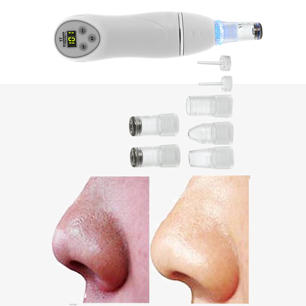 Professional Losa Blackhead Remover Tool - Deep Cleansing Pore Vacuum for Face & Nose - Acne Extractor & Blackhead Suction Kit - Perfect for Daily Skincare & Spa Treatments