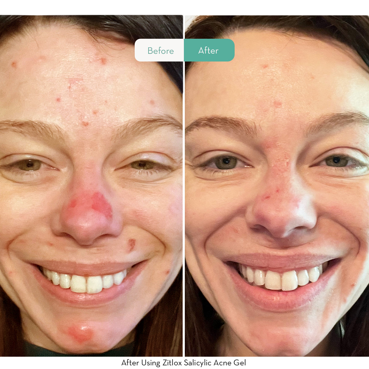 Zitlox Salicylic Acid Acne Treatment Gel - Fast-Acting Spot Treatment for Face & Body - Best for Teen & Adult Acne, Pimples & Breakouts - Use for Oily Skin, Blackheads & Blemishes