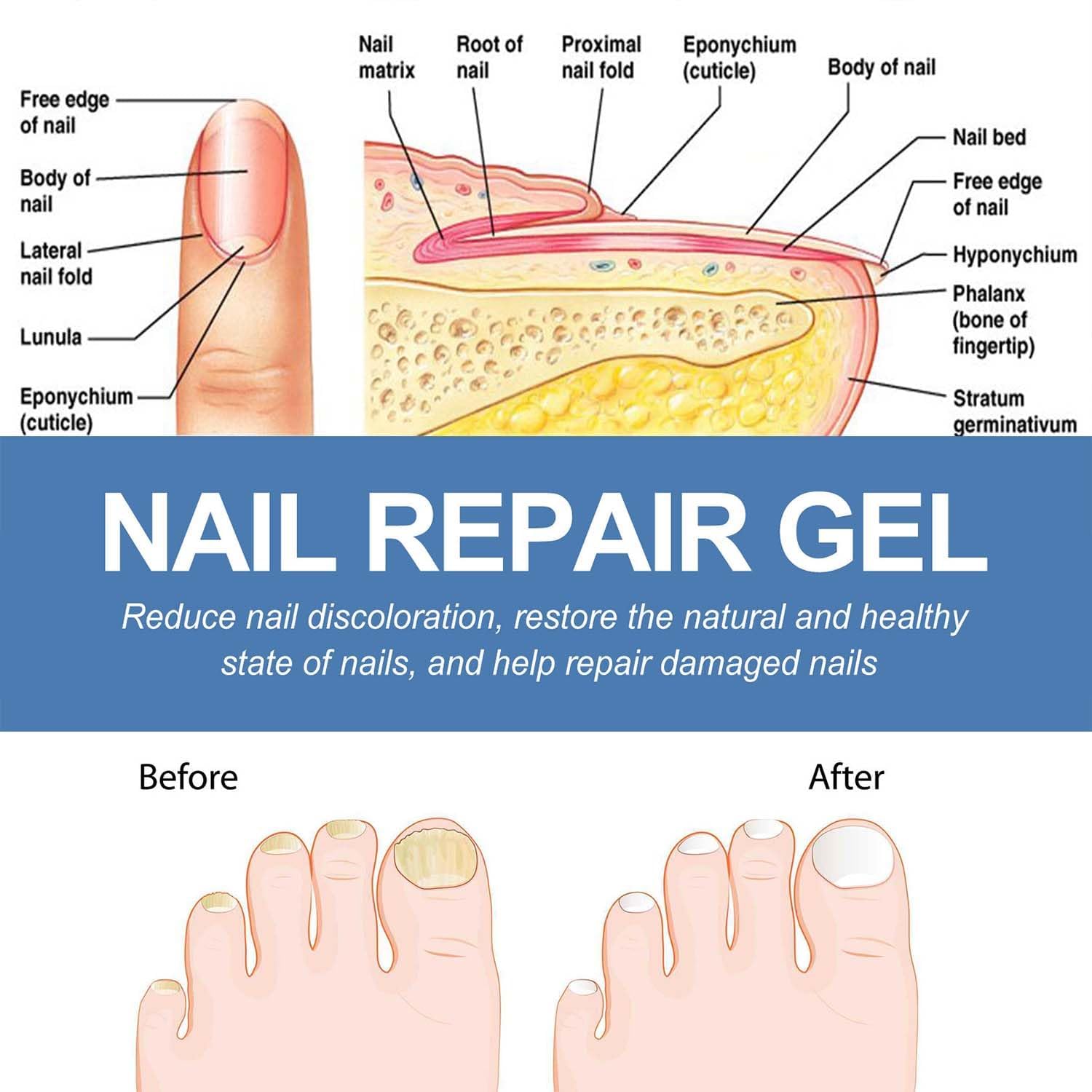 Postur Nail Gel - Fungus Treatment & Nail Care for Damaged & Discolored Nails - Strengthens & Restores Healthy Nails - Perfect for Toenail & Fingernail Fungus Treatment at Home (1pc)