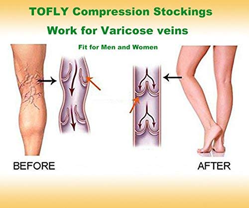 TOFLY® 30-40mmHg Medical Compression Socks for Men & Women - Open Toe Knee High Support Socks for Circulation, Varicose Veins, Edema & Shin Splints - Firm Graduated Compression for Nurses, Athletes & Travelers - Beige XL