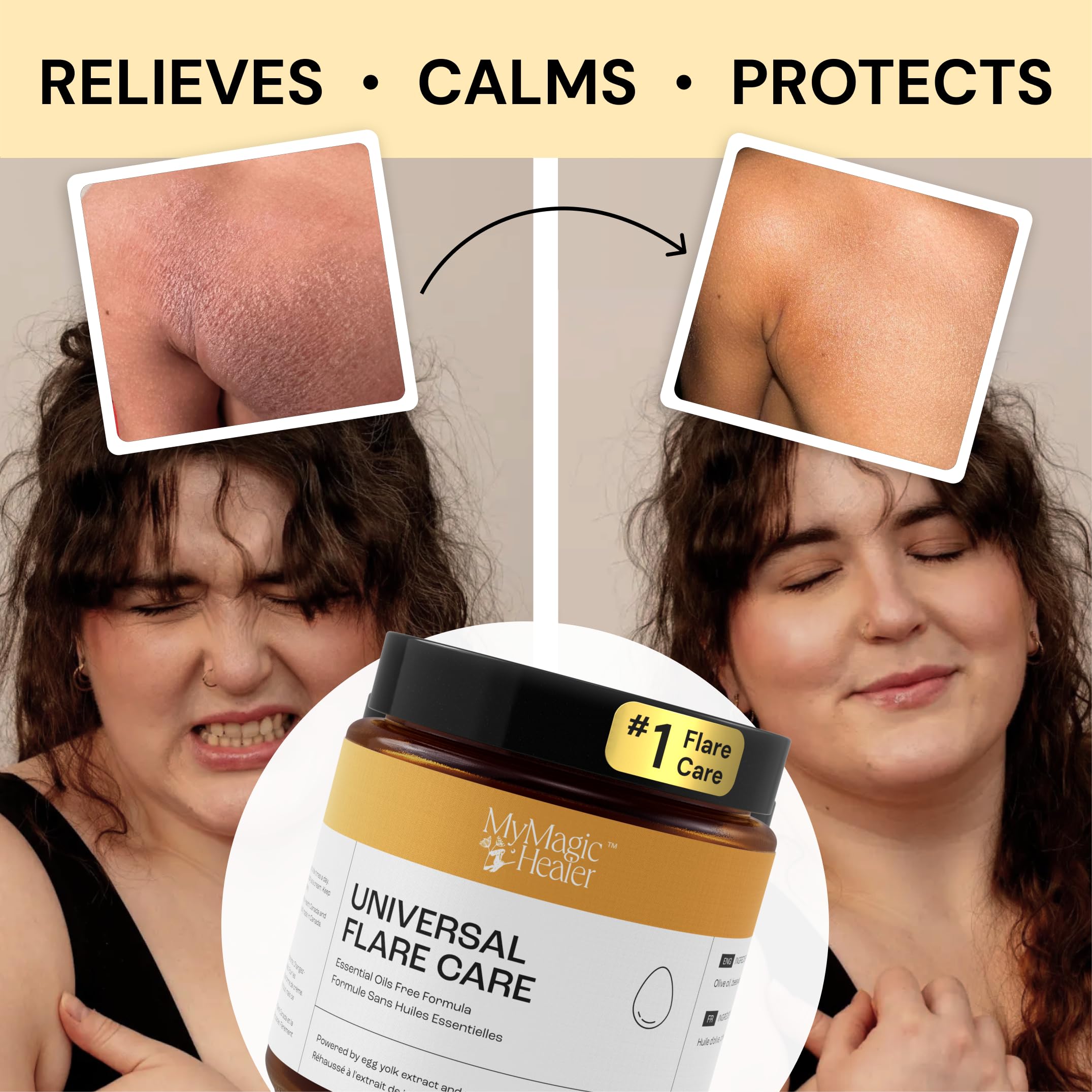 Universal Flare Care Soothing Skin Balm - Propolis & Egg Yolk Formula for Eczema, Dermatitis, Psoriasis Relief | Fragrance-Free Solution for Rashes, Baby Skin, Hidradenitis, Chafing & Wounds | 4oz | Perfect for Daily Skin Care & Sensitive Skin Needs