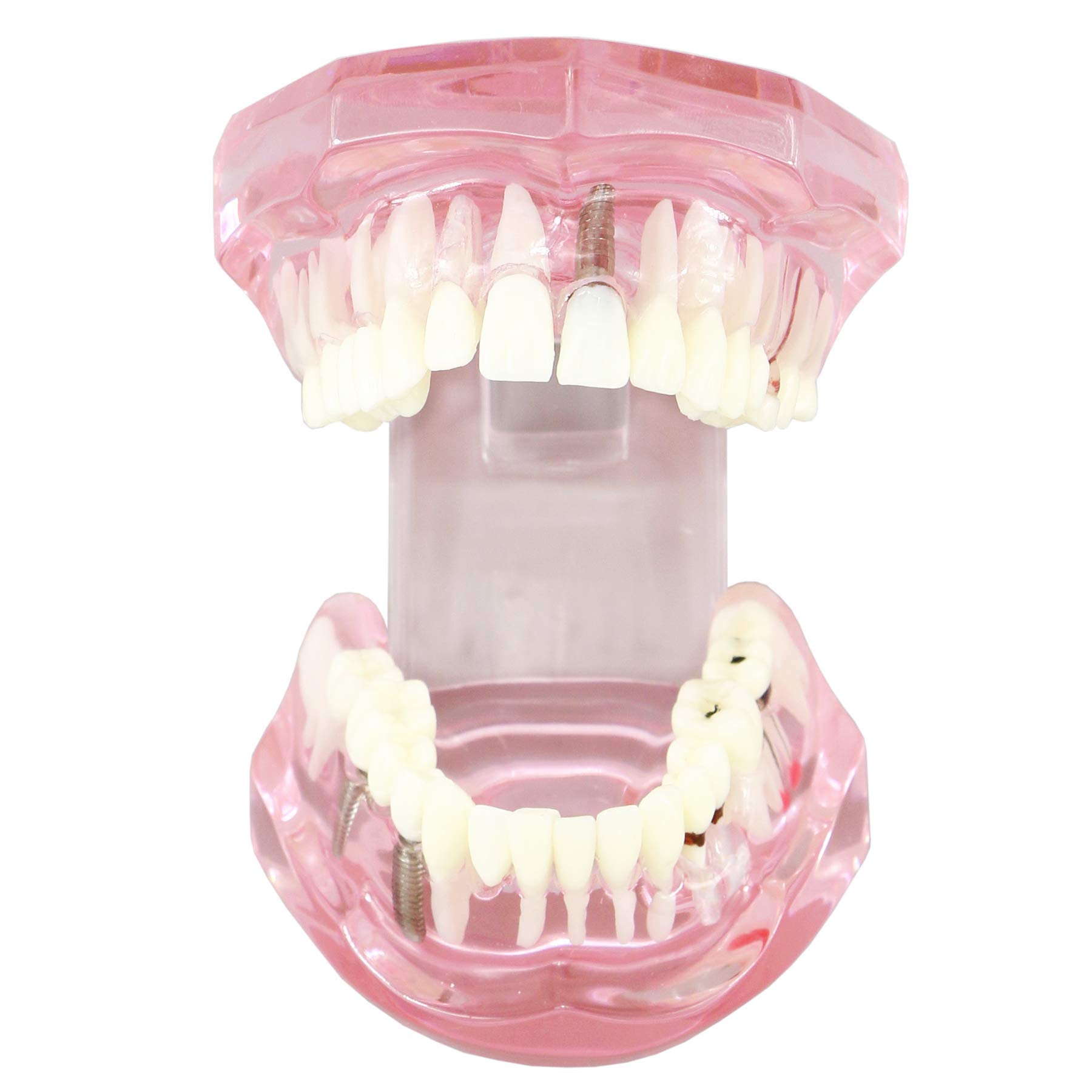 Dental Teeth Model - Implant Restoration Bridge Typodont for Dental Teaching & Study - Oral Pathology Demonstration (M2001 Pink) - Perfect for Dental Schools, Clinics & Training Labs
