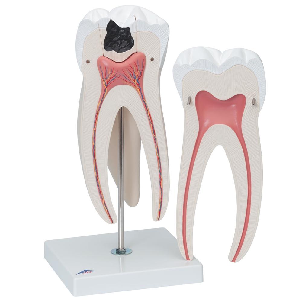 Giant Molar with Cavities - 15x Life Size Dental Model (5-Part) - Perfect for Dental Education, Classroom Demonstrations & Medical Training