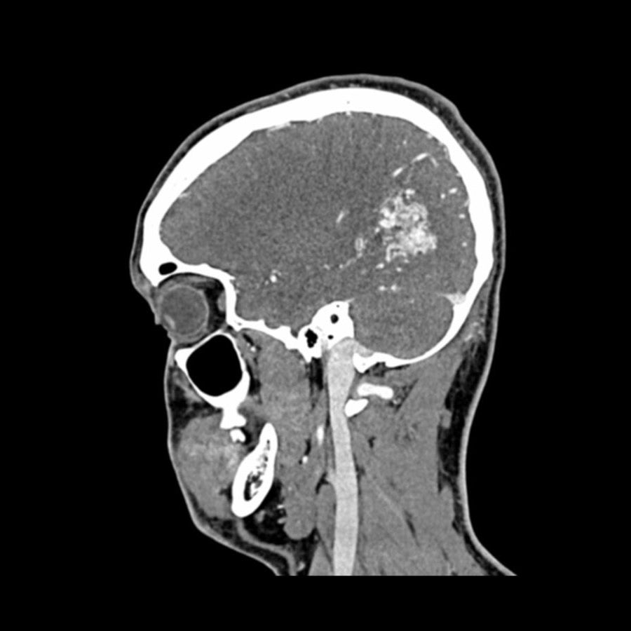 Head and Neck CTA Phantom AVM for CT Scan & X-Ray Training - Medical Imaging Practice, Radiology Education, and Diagnostic Testing
