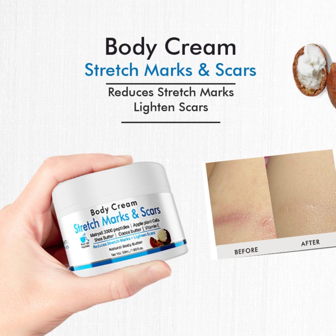 Volamena Stretch Marks & Scars Removal Cream - 50ml Moisturizing Body Lotion for Pregnancy, Weight Loss & Skin Repair - Perfect for Postpartum Care & Daily Hydration