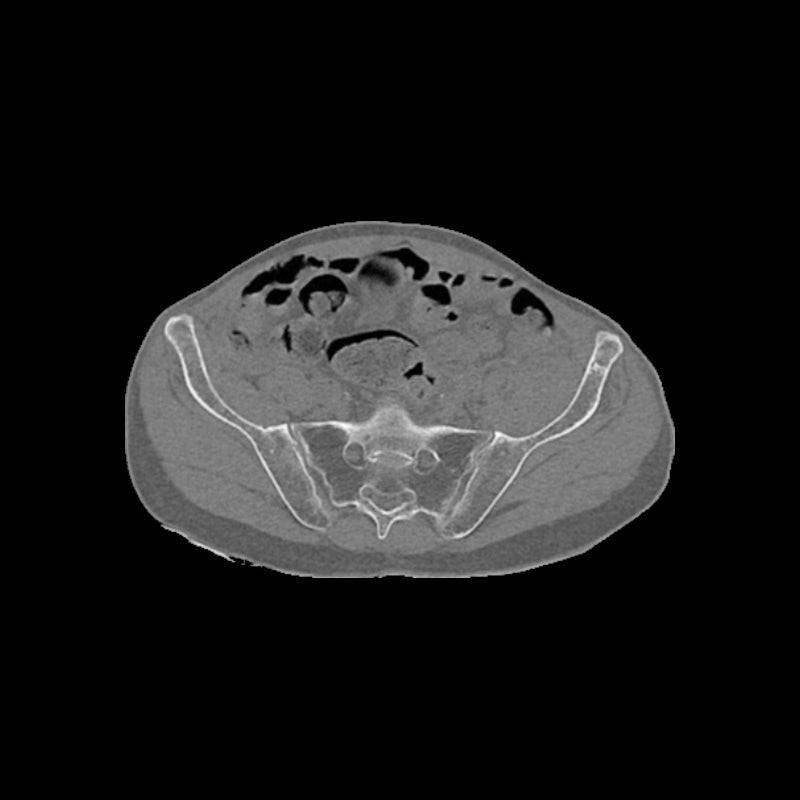 High-Quality Femoral Neck Fracture Pelvis Phantom for CT Scan & X-Ray Training - Perfect for Medical Education & Radiology Practice