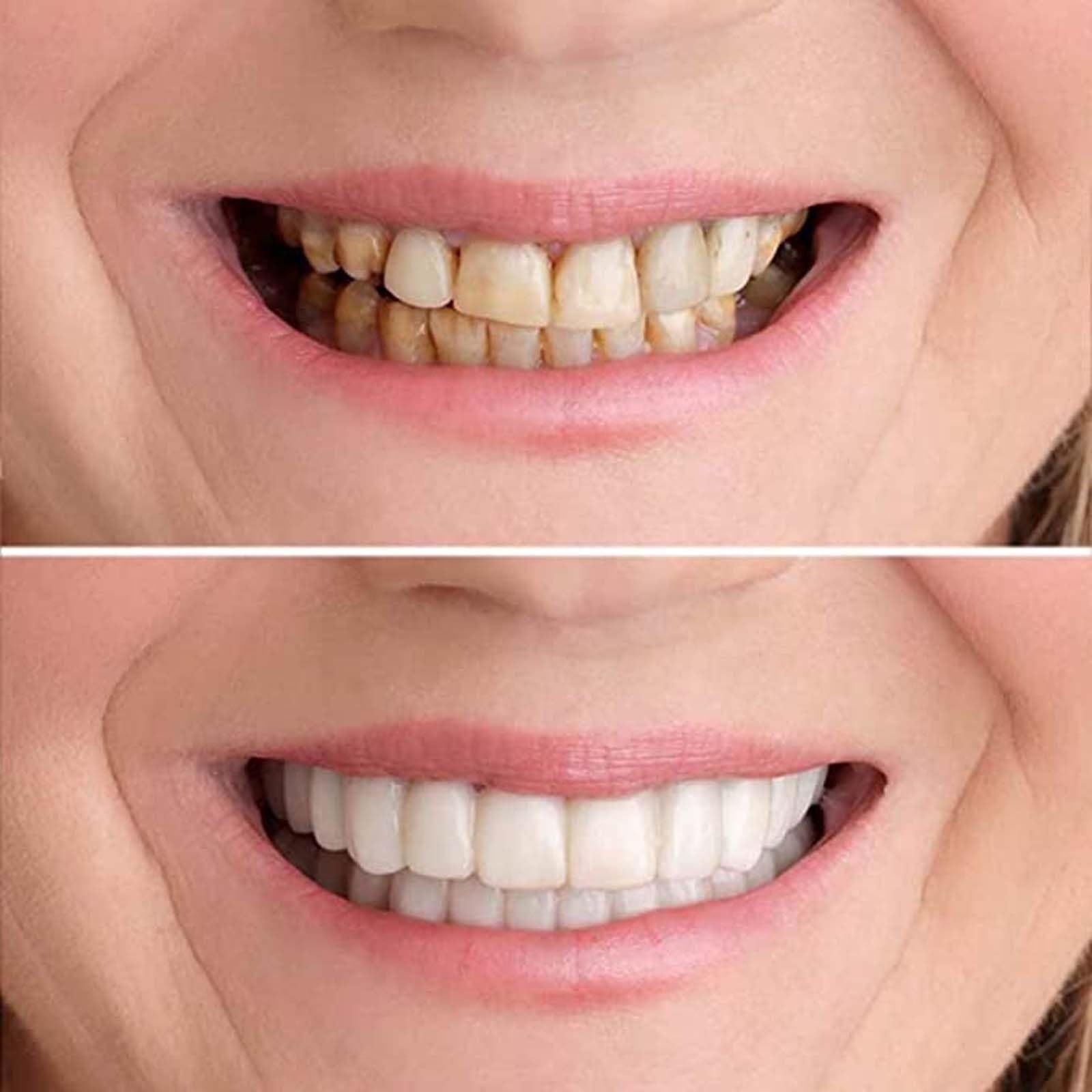 Natural & Comfortable Temporary Fake Teeth for Women & Men - Cosmetic Denture Veneers for Upper & Lower Jaw to Regain Confident Smile | Perfect for Parties, Weddings, and Daily Wear