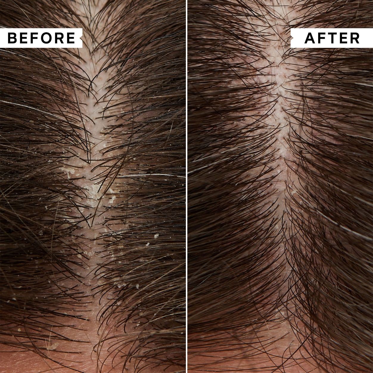 Flaky Scalp Hydrating Conditioner for Dry Scalp Treatment - Soothes Itching & Dandruff Relief - Perfect for Daily Hair Care & Scalp Moisturizing