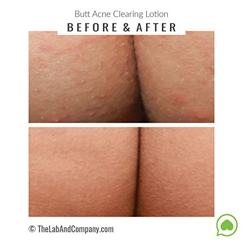Best Clearing Lotion for Body Acne - Treat Back, Bum & Thigh Breakouts | Gentle Exfoliating Formula for Smooth Skin | Perfect for Post-Workout & Daily Skincare Routine